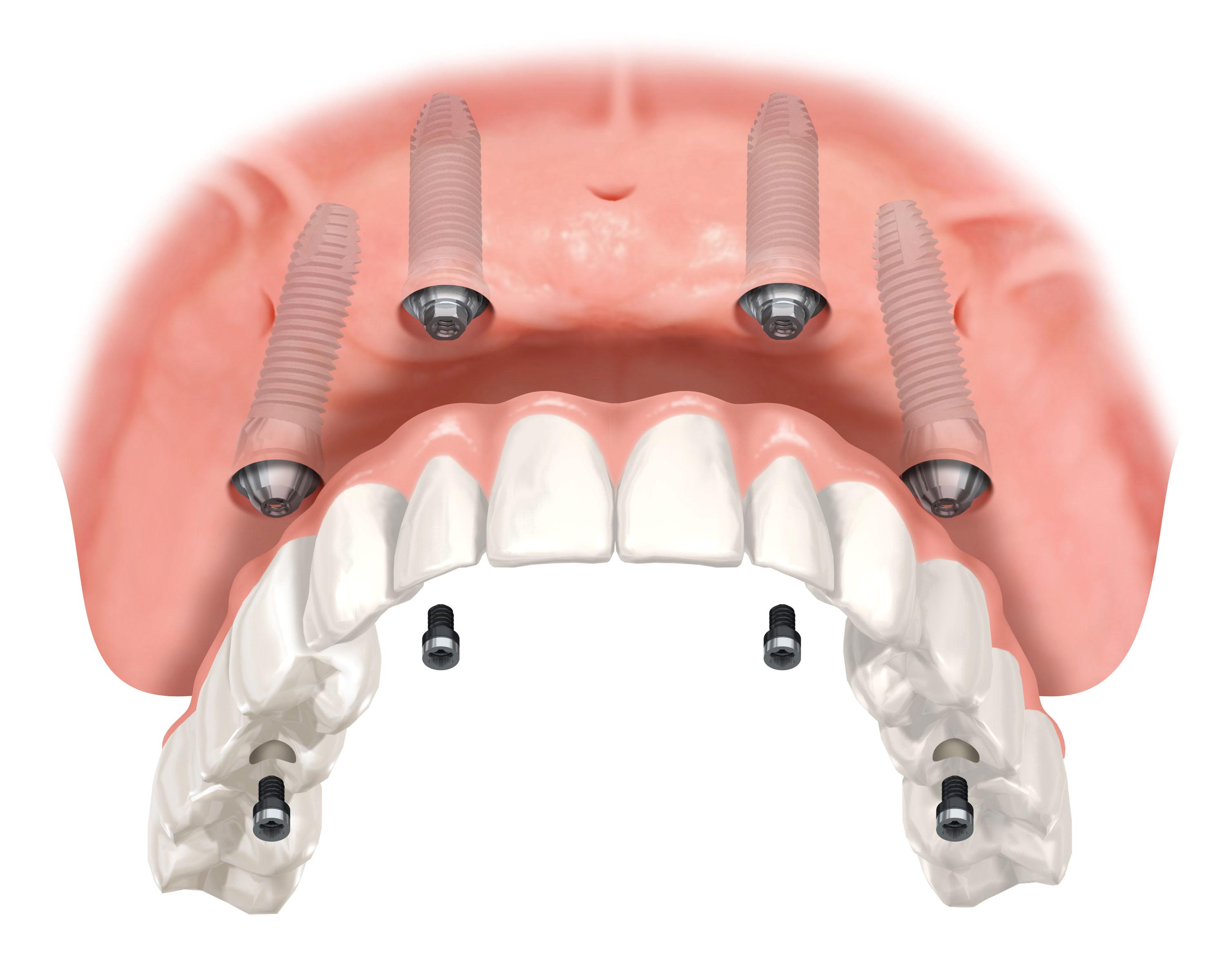All-on-Four Implants vs Dentures