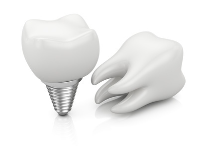 Top Advantages of Dental Implants