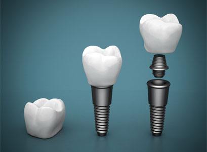 dental implants process