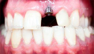 dental implant colorado