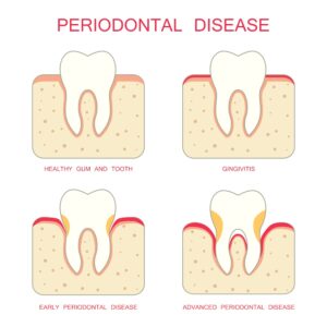 Periodontal Disease