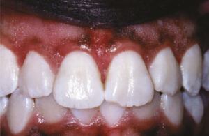 Full Denture rehabilitation