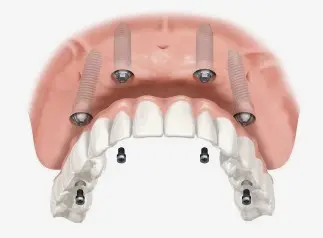 Altura Implant