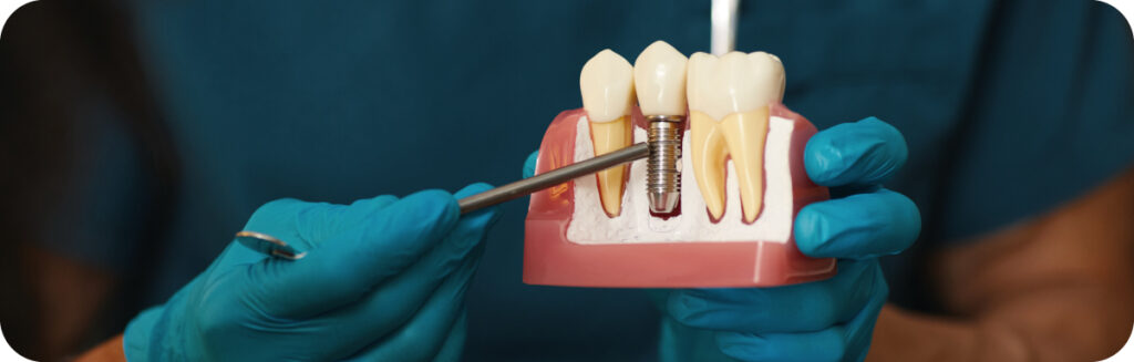 Combine Orthodontics and Dental Implants