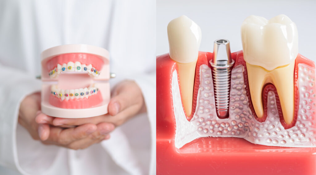 Wondering if you can straighten your teeth with braces or aligners after getting dental implants? Here’s what you need to know.