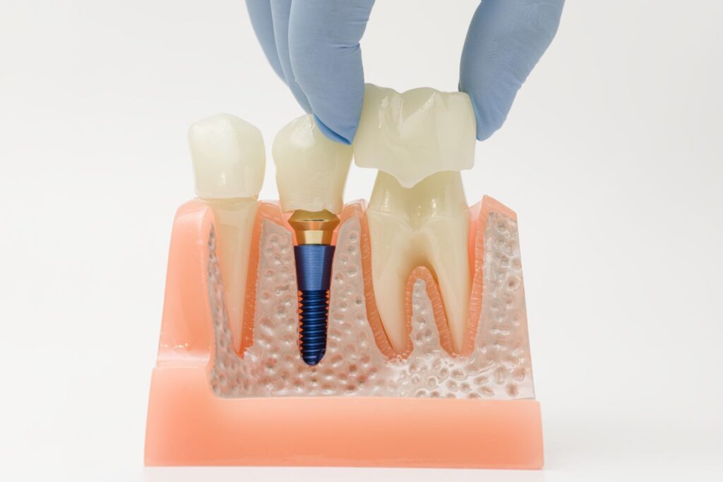 The decision between a screw retained vs cement retained implant crown goes beyond technical details. They differ in structure, maintenance, and how issues are managed down the line.