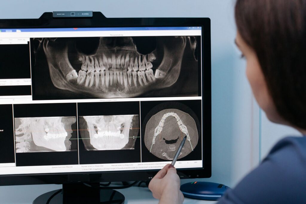 CBCT Scan for Dental Implants: Why 3D Imaging Matters